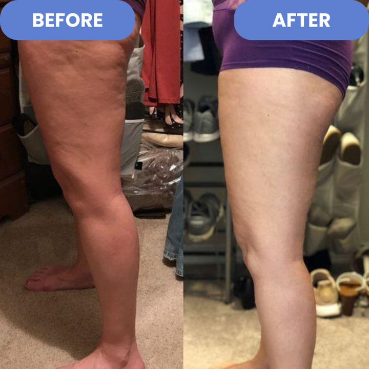 Reducer cellulite og strækmærker med dette avancerede massageapparat.