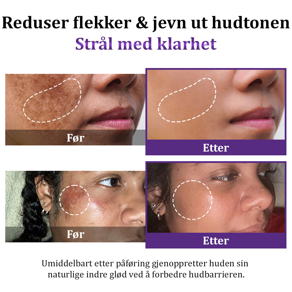 Specialcreme til kvinder: Reducerer mørke pletter, melasma og forbedrer hudens glød og en jævn tone.