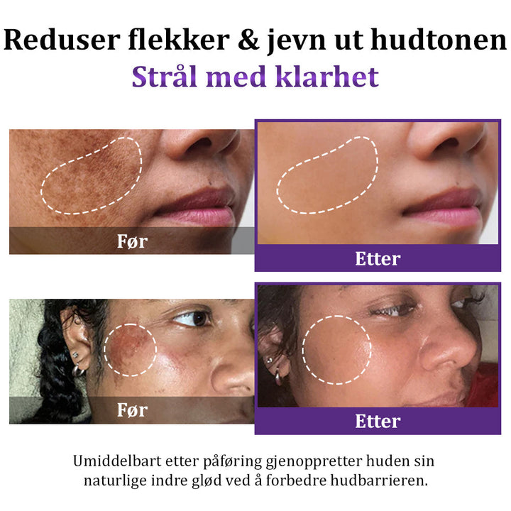 Specialcreme til kvinder: Reducerer mørke pletter, melasma og forbedrer hudens glød og en jævn tone.