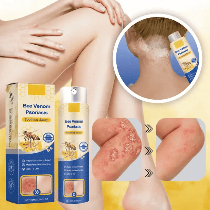 Psoriasis Hudpleje Spray: Øjeblikkelig lindring mod kløe, rødme og tør hud. Naturlig formel.