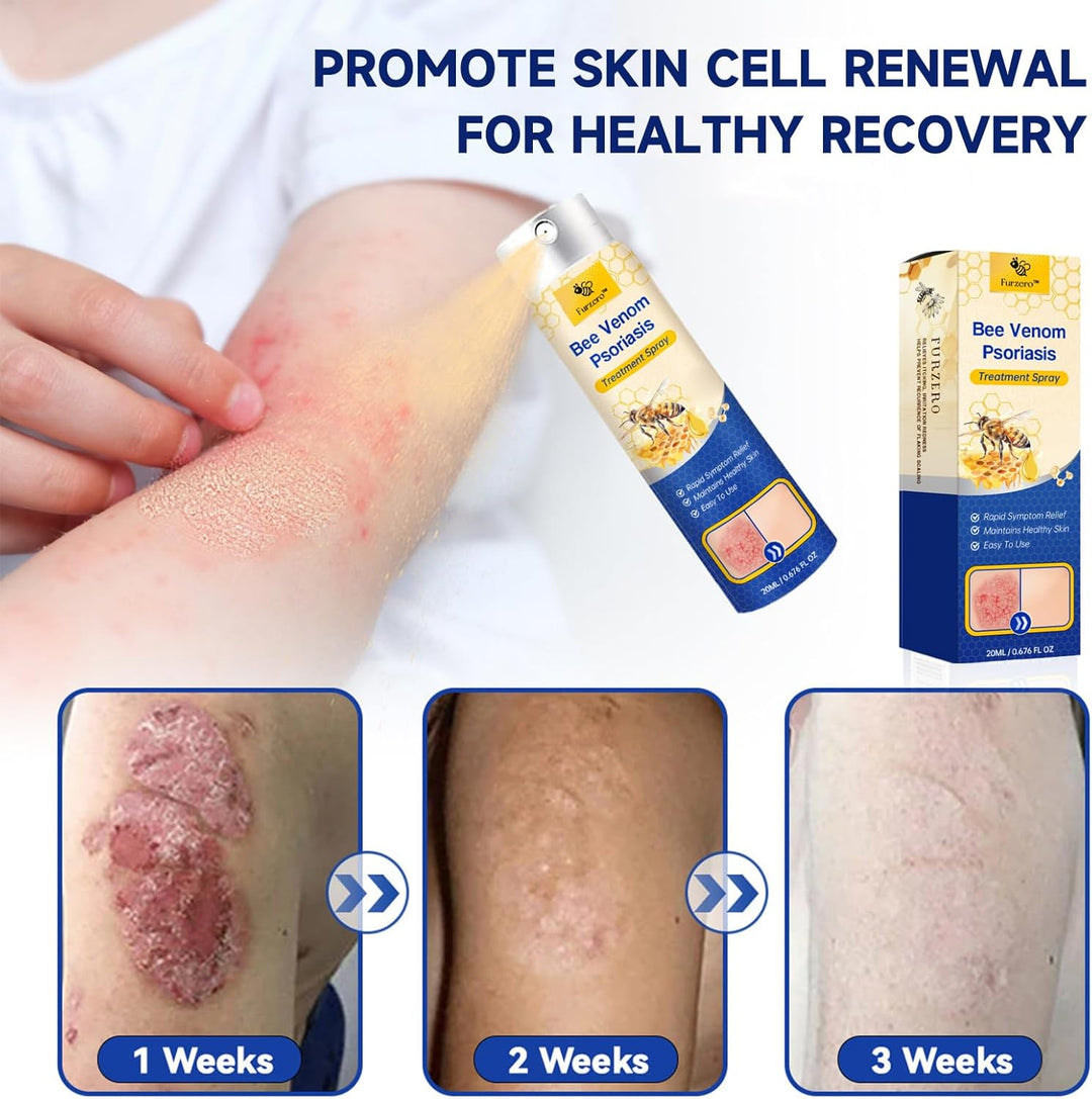 Effektiv spray mod psoriasis, eksem, kløe og tør hud. Hudpleje der lindrer hudirritation og genopretter huden.