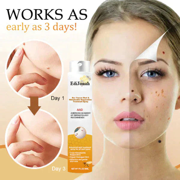 Effektiv SkinClear vortefjerner spray for skånsom behandling af vorter og hudmærker på huden.