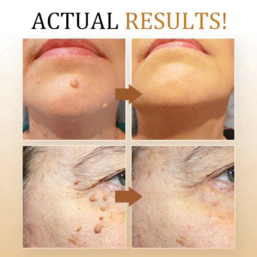 SkinClear vortefjerner spray til nem og hurtig fjernelse af vorter og hudmærker. Hudpleje.