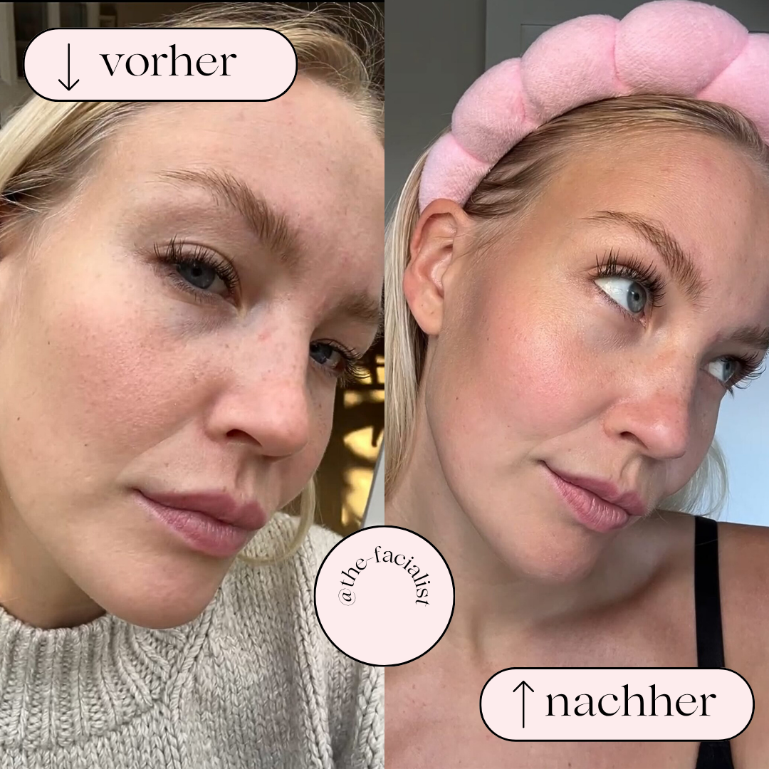 Produktbillede af Unisex Hydrodermabrasion ansigtsrenser; en komplet løsning til hudpleje derhjemme.