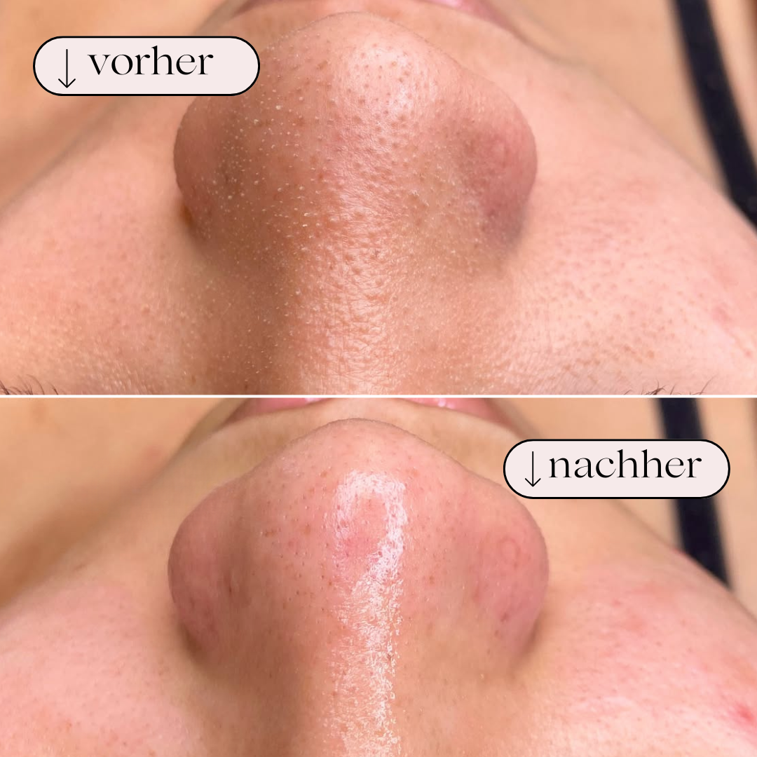 Hydrodermabrasion ansigtsrenser med ilt; garanterer dybderens og en frisk hud til daglig skønhed.