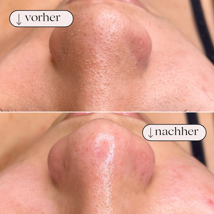 Hydrodermabrasion ansigtsrenser med ilt; garanterer dybderens og en frisk hud til daglig skønhed.