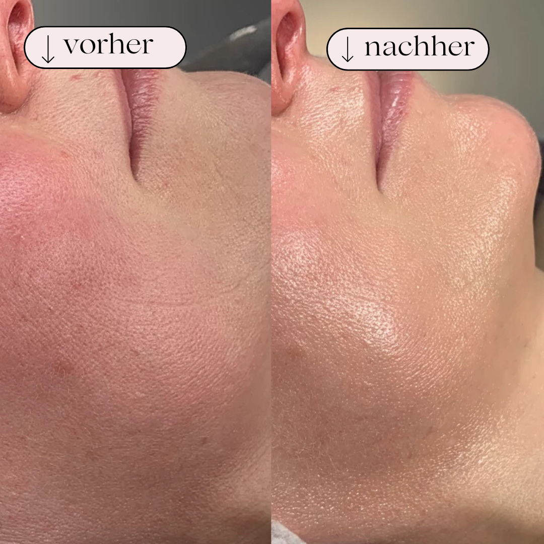 Den nye Hydrodermabrasion ansigtsrenser til iltbehandling og dyb porerens, essentiel for hudpleje.