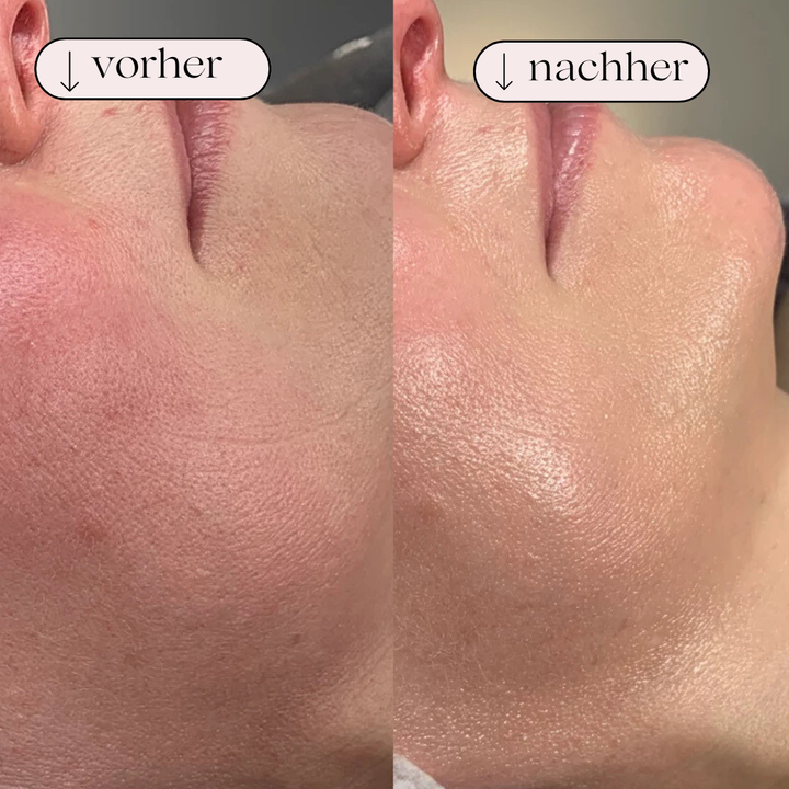 Den nye Hydrodermabrasion ansigtsrenser til iltbehandling og dyb porerens, essentiel for hudpleje.